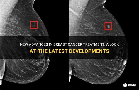 New Advances In Breast Cancer Treatment A Look At The Latest Developments Medshun