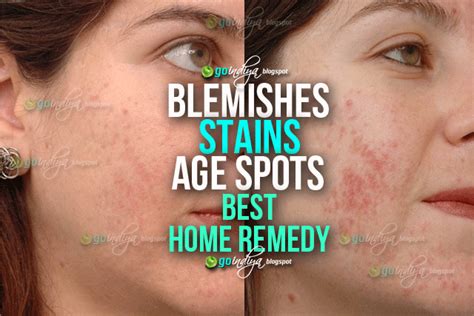 Best ever home remedy to remove blemishes, dark spots and age spots ...