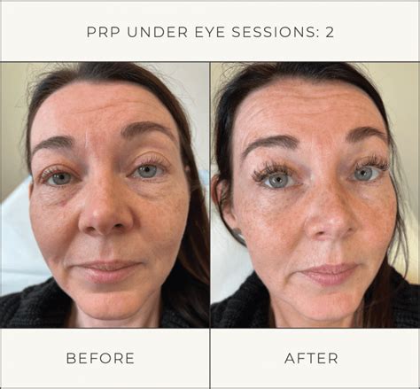 Prp Under Eye Treatment Professionals In Melbourne Plasma Therapy