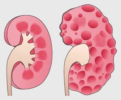 Polycystic Kidney Disease - Dr.Tathed's Homeopathy