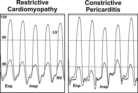 Hemodynamics In The Cardiac Catheterization Laboratory Of The St