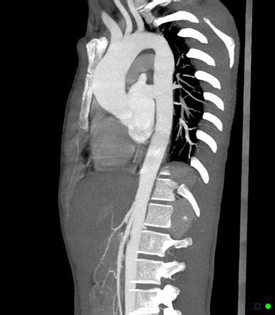 Marfan Syndrome Ascending Aorta Aneurysm Image Radiopaedia Org