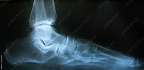 X-ray image of normal foot side. Stock Photo | Adobe Stock