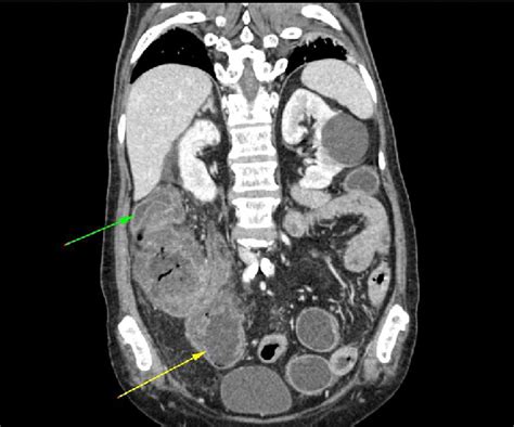 Coronal Ct Image Demonstrating A Colo Colonic Intussusception