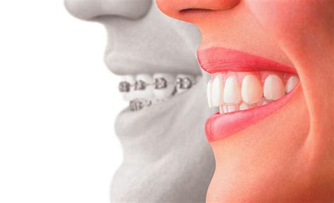 Les Bagues Ou Les Aligneurs Invisalign… Quelle Est La Meilleure Option