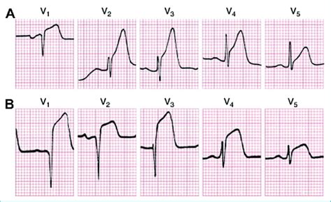 St Segment Elevation Myocardial Infarction