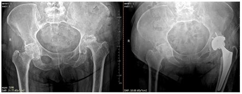 Ijerph Free Full Text Avascular Necrosis Of Femoral Headoverview