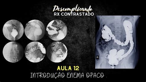 Enema Opaco Como É Feito - AULA 12- Introdução ao Enema opaco - YouTube
