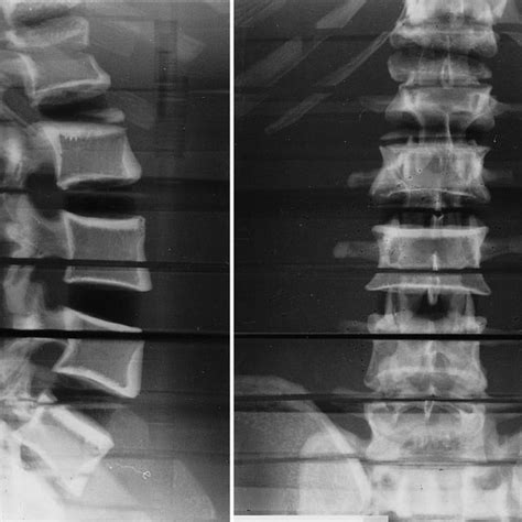 (PDF) 'Anode heel effect' on patient dose in lumbar spine radiography