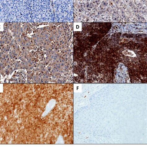 Expression Pattern Of Trk Protein And P16 Using Immunohistochemistry Download Scientific