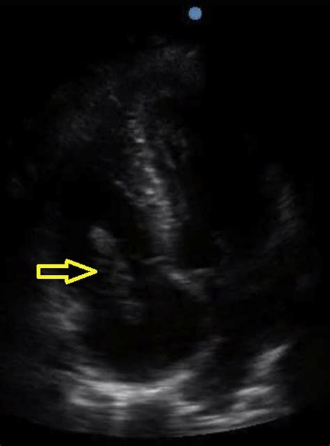 Clot In Transit Point Of Care Ultrasound Diagnosis Of Acute Pulmonary