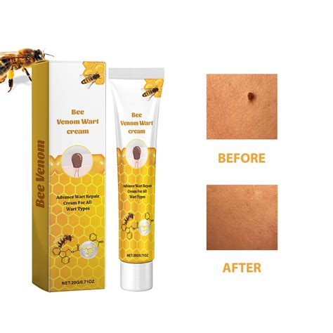 Cengzishu Wart Removal For Removing Removing Wart And Removing Formula