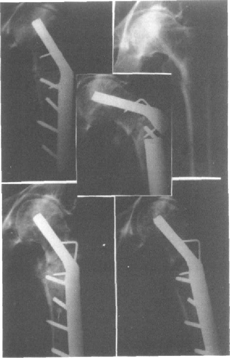 Figure 2 From Fracturas Laterales Inestables Del Cuello De Fémur