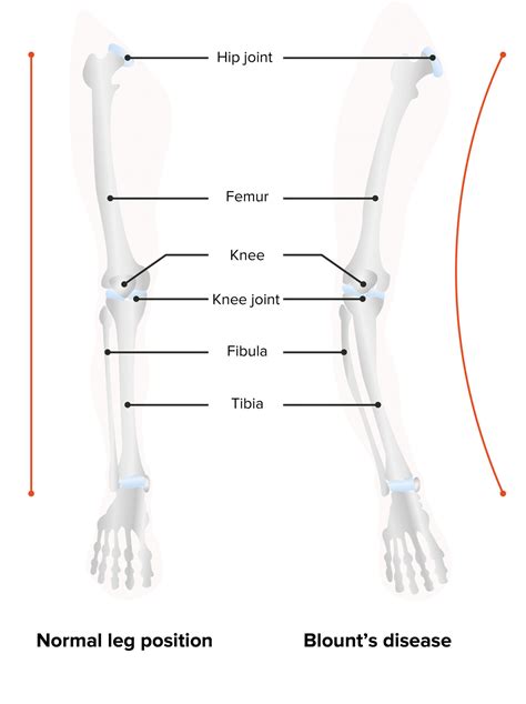Blount's Disease | Concise Medical Knowledge
