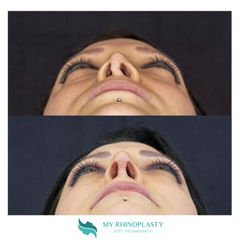 Naso Chiuso Cose Che Devi Sapere My Rhinoplasty