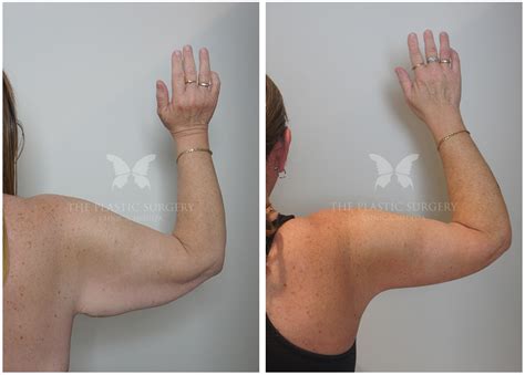 Arm Lift Surgery Before And After Photos🎮 Descubra O Mundo Da Diversão