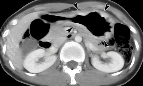 Is Stomach Cancer Curable? Diagnosis, Staging and Treatment