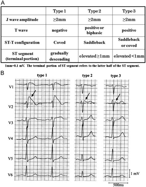 Brugada Ecg Findings