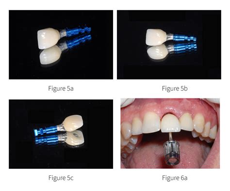 Maxillary Central Incisor Implant Supported Crown - Osstell®