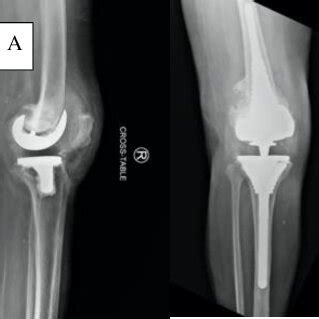 A Preoperative Radiographs Showing The Supracondylar Periprosthetic