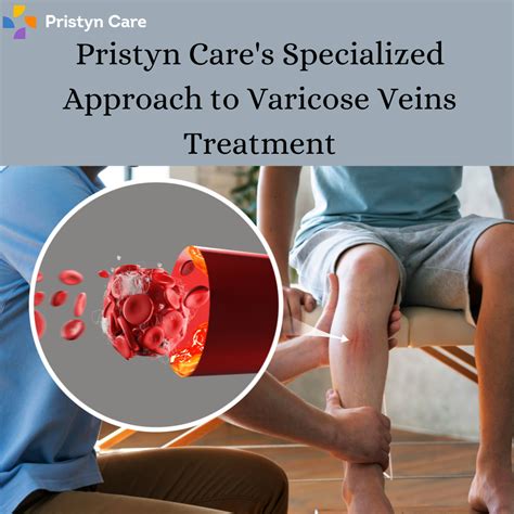 Pristyn Cares Specialized Approach To Varicose Veins Treatment By