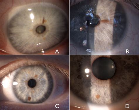 New Insights Into Oculodermal Nevogenesis And Proposal For A New Iris