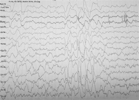 Electroencephalography Demonstrated An Intermittent Burst Of