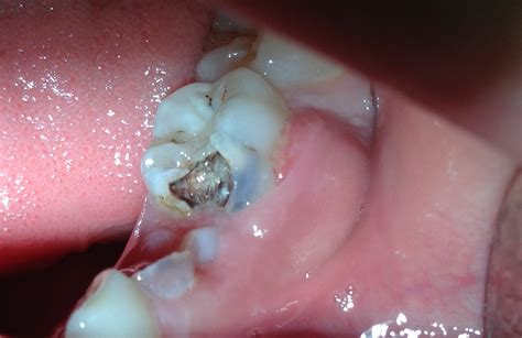 Case 5 Pediatric Dentistry What Is A Dental Abscess What Causes It Dental Tube