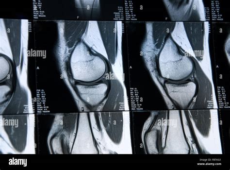 mri knee Stock Photo - Alamy