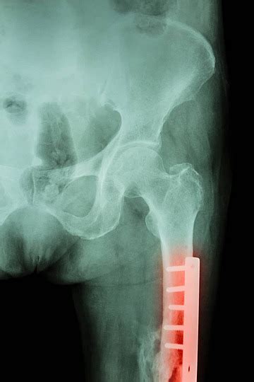 Surgery On Fractured Femur Thigh Bone Detected By Xray Film And Interconnected Photo Background ...