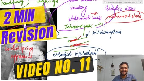 Intussusception Video No 11 Youtube