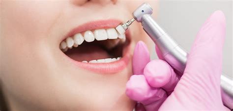 Limpiezas Dentales Son Importantes Cl Nica Dental San Basilio Murcia