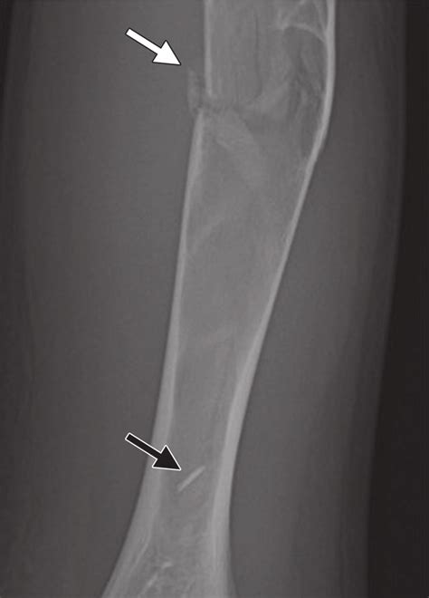 Simple Bone Cyst Fallen Fragment Sign