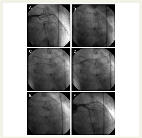 The Culotte Technique For Coronary Bifurcation Stenting A Baseline