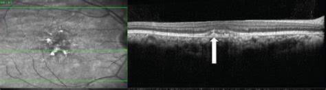 A And B Multicolour Images A Showing Retinal Pigment Epithelial