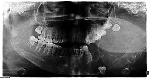 An Orthopantomograph Showing An Expansile Multilocular Radiolucent