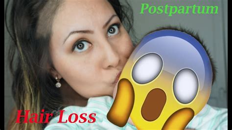 Postpartum Hair Loss Coverage Youtube