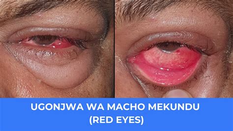 Ufahamu Ugonjwa Wa Macho Mekundu RED EYES Sababu Dalili Kinga Na