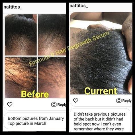 Using Monistat For Hair Growth