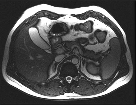 Mr Elastography Spleen Stiffness Measurements In Healthy Volunteers