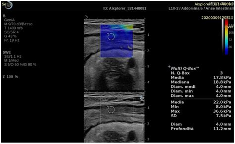 Gastroesophageal Junction Ultrasound