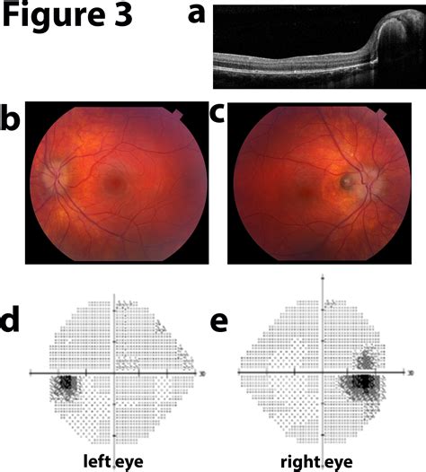 Moran Core Photographic Essay Of Idiopathic Intracranial Hypertension