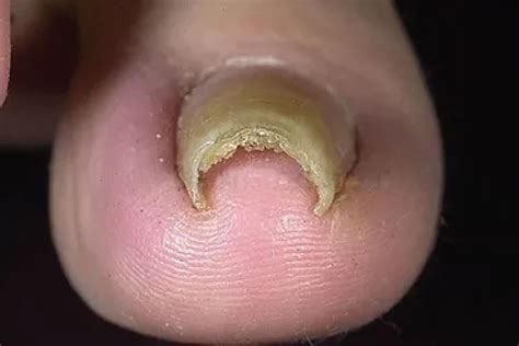 Pincer Nail