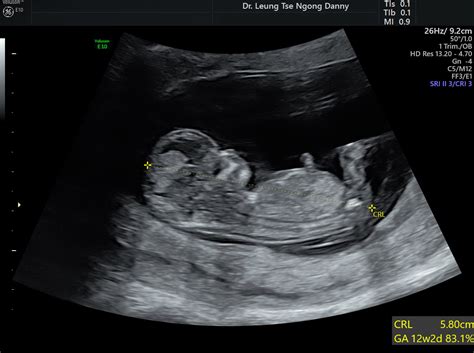 Fetal Biometry HKOG INFO