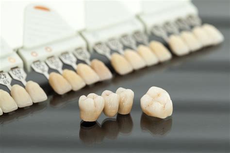 Implantes dentales o puentes dentales qué tratamiento elegir Sanz