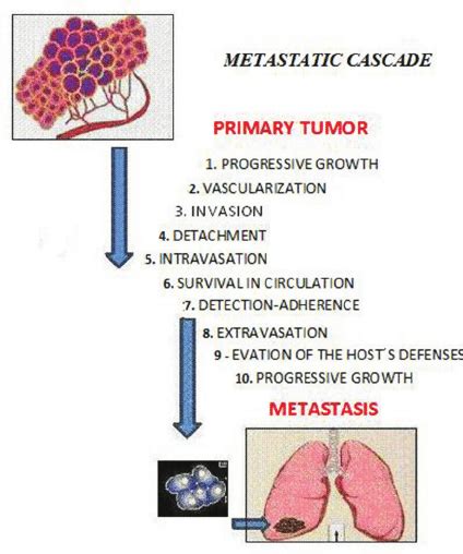 The Sequential Steps In The Pathogenesis Of Metastasis Are Shown In The