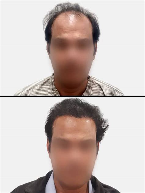 Before And After Hair Transplant 10 Best Hair Transplant Results In