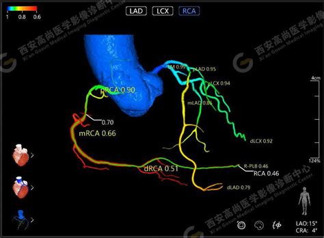 医学影像之冠状动脉ct血流储备分数ai定量分析（ct Ffr）医学影像血流储备定量分析 健康界