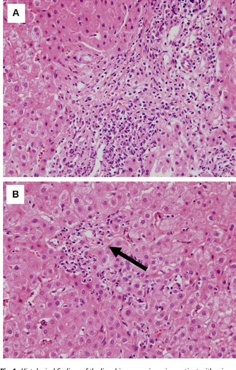 Figure 1 From Successful Treatment Of Primary Biliary Cirrhosis With Etanercept In A Patient