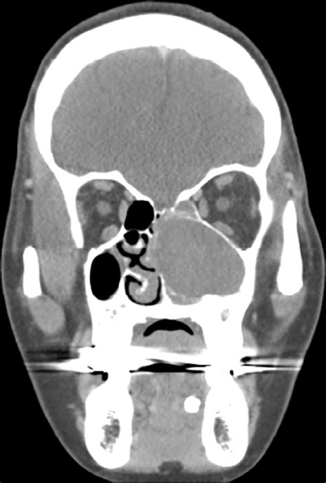 Computed Tomography Based Differential Diagnosis Of Fungus Balls In The